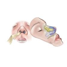 OSSEOUS Internal Nasal Airways Splint -Standard